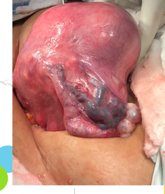 VARICES PELVICAS